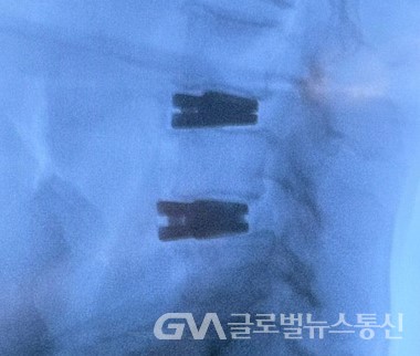 (사진제공:엘앤케이바이오메드)엑셀픽스 XTP 척추 수술 첫 케이스 엑스레이 촬영 사진(측면)